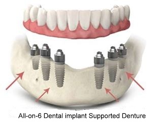 All-on-4 ( all-on-6) Dental Implant