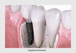 Implant dentaire