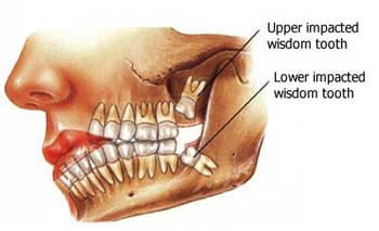 wisdom-teeth-modern-dental-care