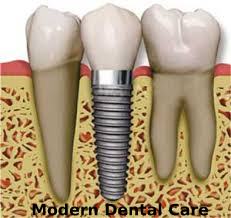 Implants Dentaire