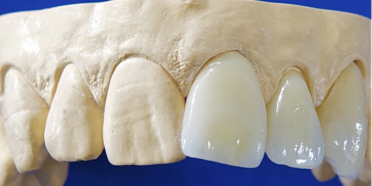 Zirconia Dental Crowns