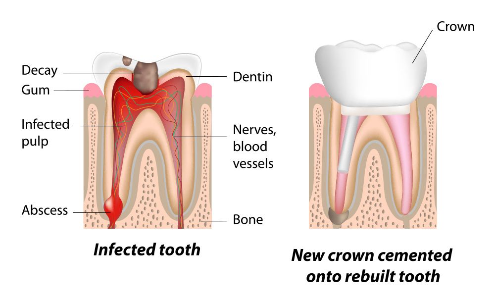Crown-Root-Canal-Modern-Dental-Care