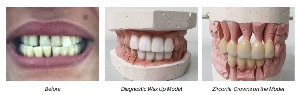 Diagnistic Wax-Up model and Zirconia Crowns