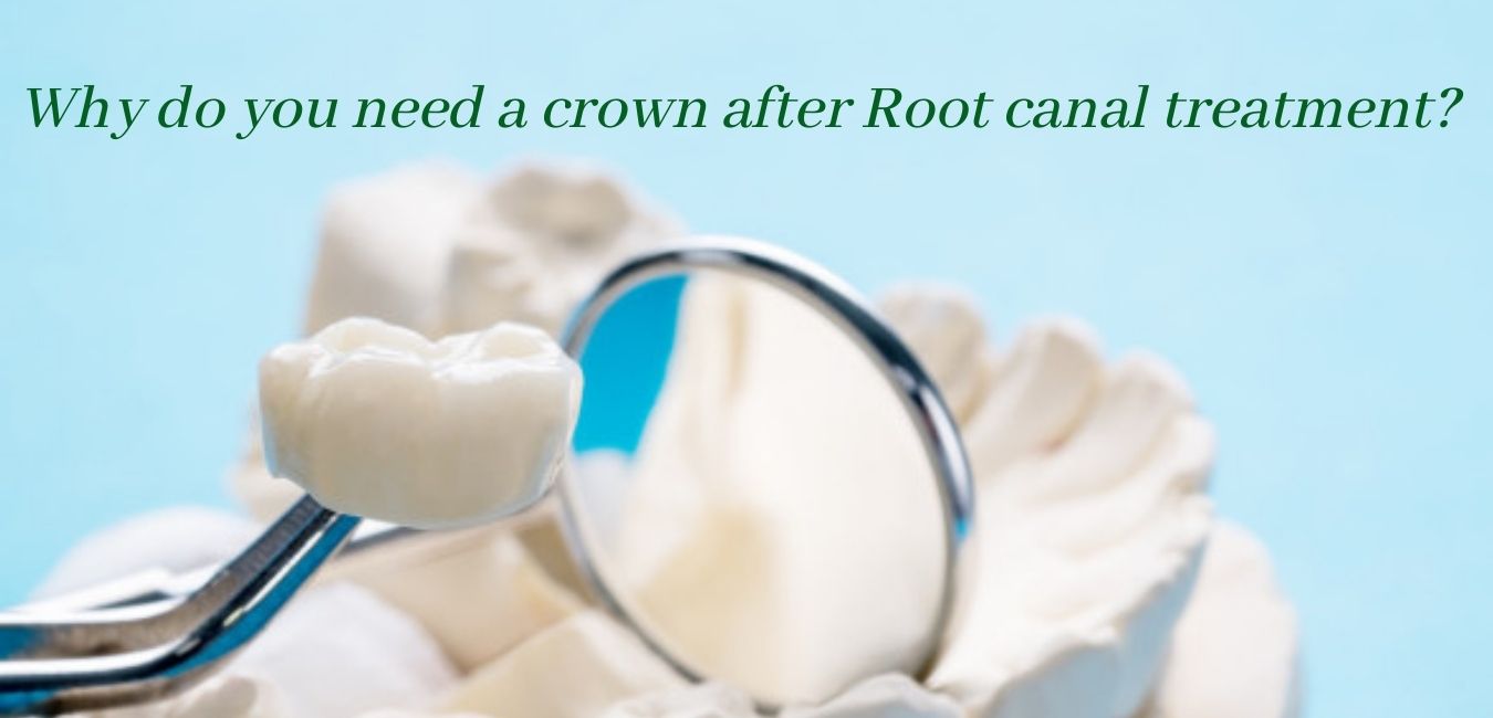 Crown After Root Canal