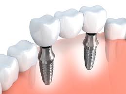 Dental bridge over implants