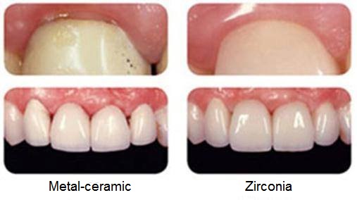 Metal-ceramic vs  Zirconia