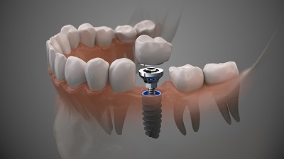 Crown over implant