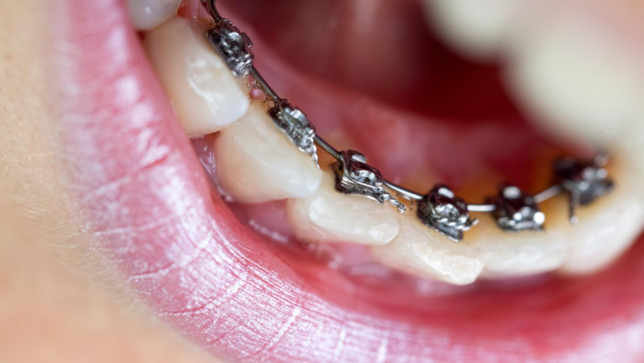 Different Types Of Braces Modern Dental Care Orthodontic Treatment